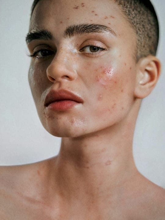 Treat acne with expert guidance: step-by-step solutions
